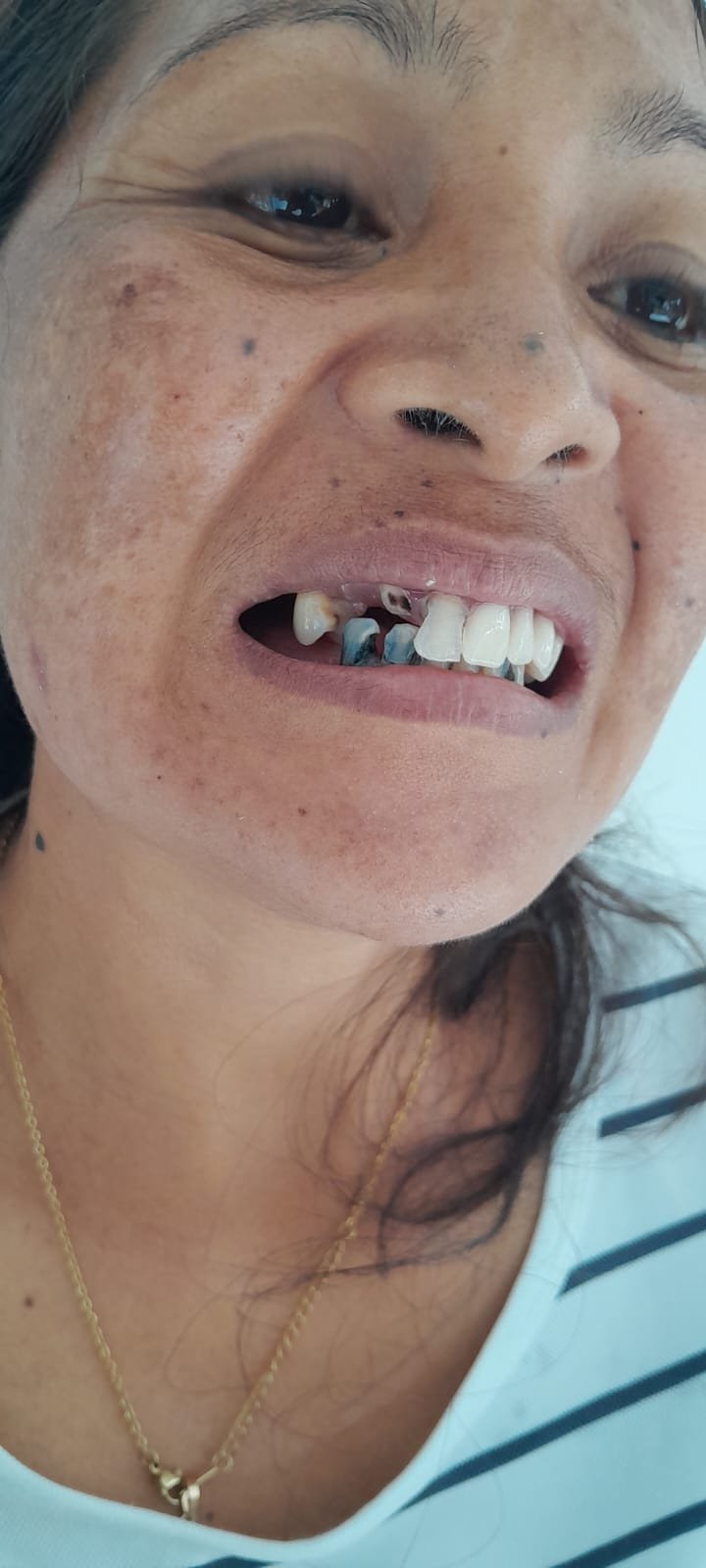 bali gigi tukang gigi dokter gigi bali reparasi gigi tambal gigi 1