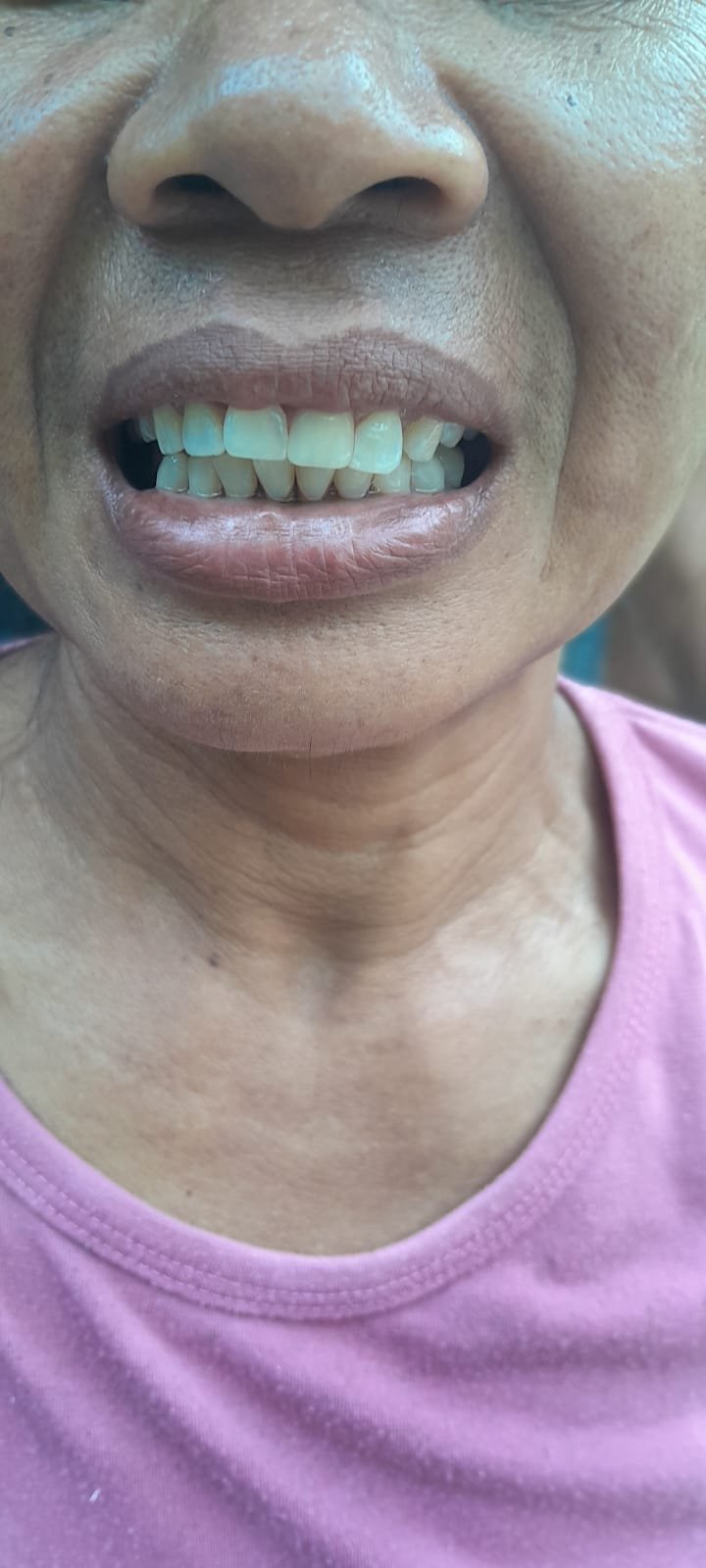 bali gigi tukang gigi dokter gigi bali reparasi gigi tambal gigi 10