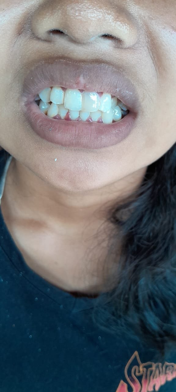 bali gigi tukang gigi dokter gigi bali reparasi gigi tambal gigi 12