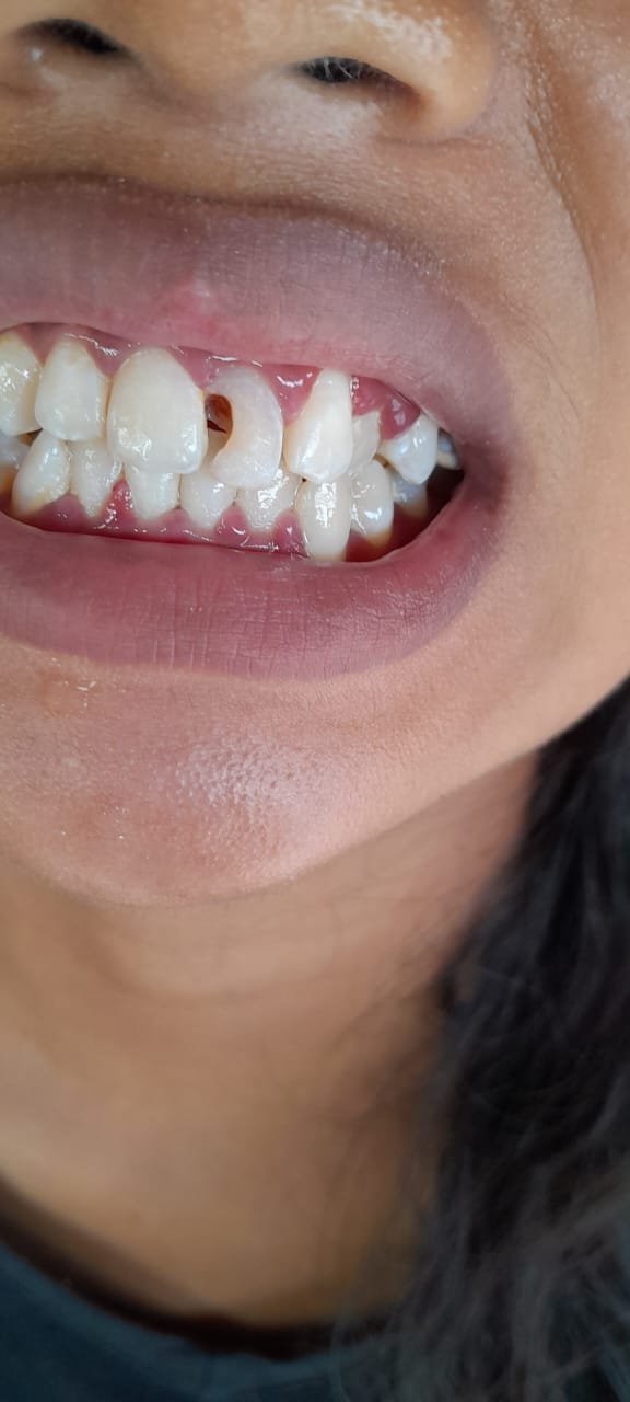 bali gigi tukang gigi dokter gigi bali reparasi gigi tambal gigi 14