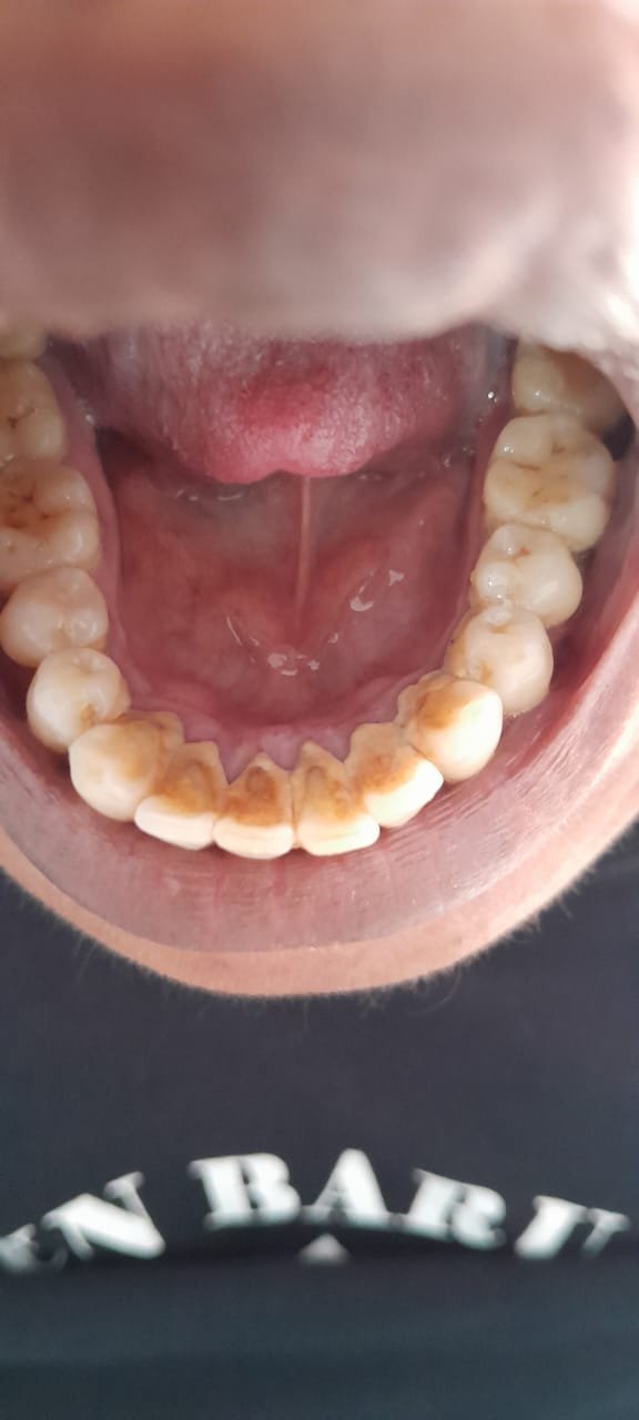 bali gigi tukang gigi dokter gigi bali reparasi gigi tambal gigi 16