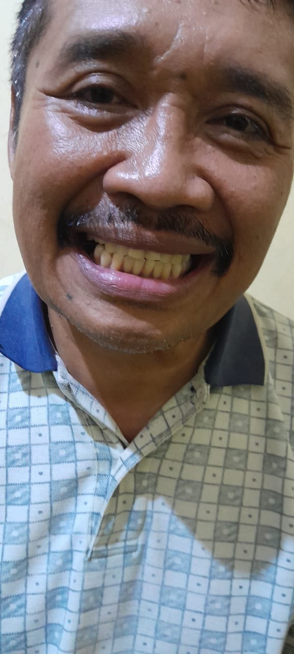 bali gigi tukang gigi dokter gigi bali reparasi gigi tambal gigi 17