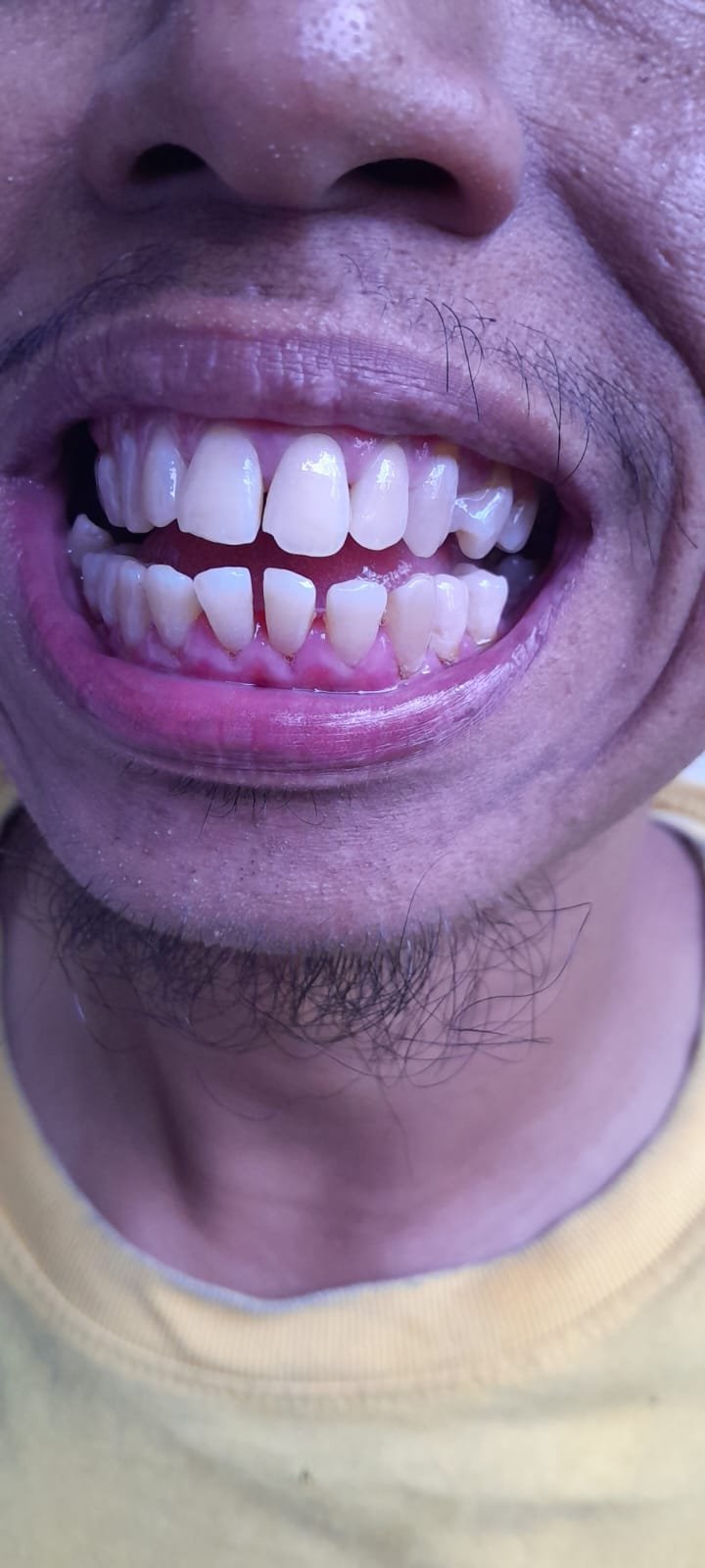 bali gigi tukang gigi dokter gigi bali reparasi gigi tambal gigi 18