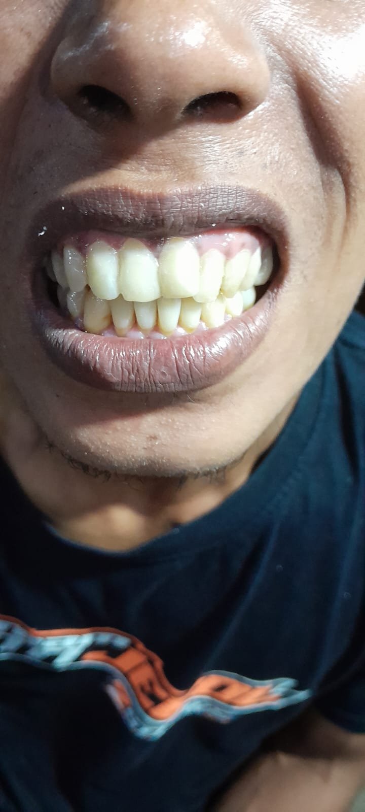 bali gigi tukang gigi dokter gigi bali reparasi gigi tambal gigi 20