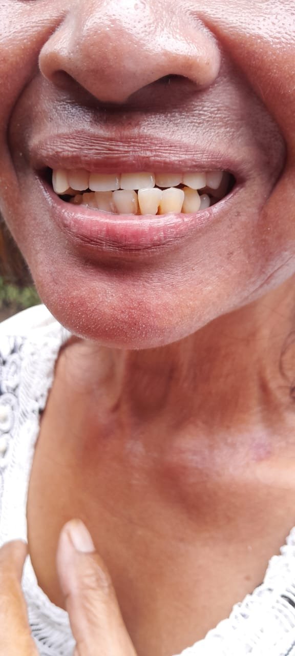 bali gigi tukang gigi dokter gigi bali reparasi gigi tambal gigi 21