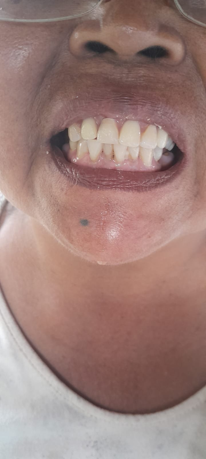 bali gigi tukang gigi dokter gigi bali reparasi gigi tambal gigi 23
