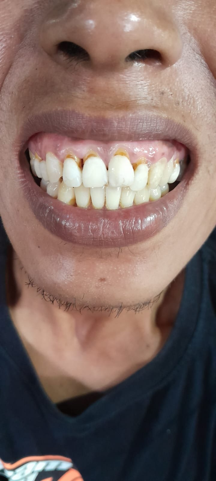 bali gigi tukang gigi dokter gigi bali reparasi gigi tambal gigi 24