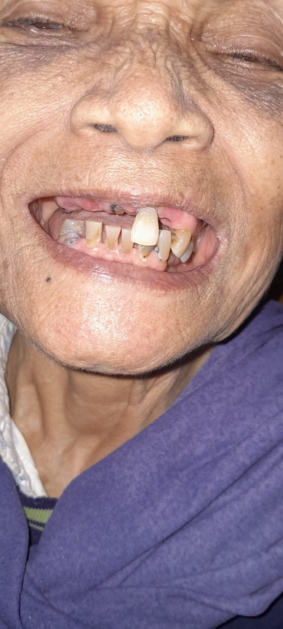 bali gigi tukang gigi dokter gigi bali reparasi gigi tambal gigi 3
