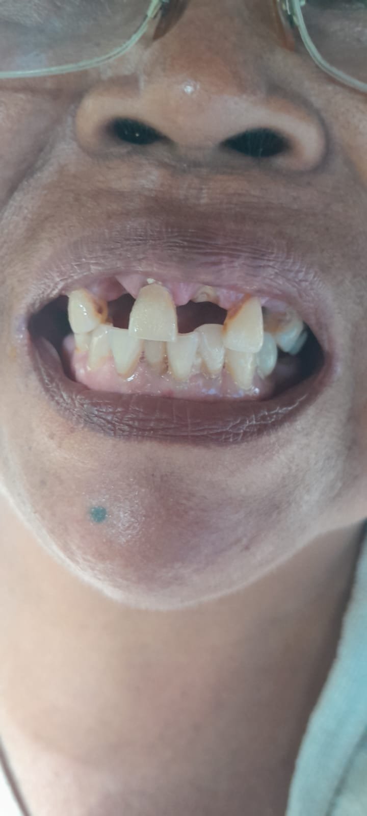 bali gigi tukang gigi dokter gigi bali reparasi gigi tambal gigi 7