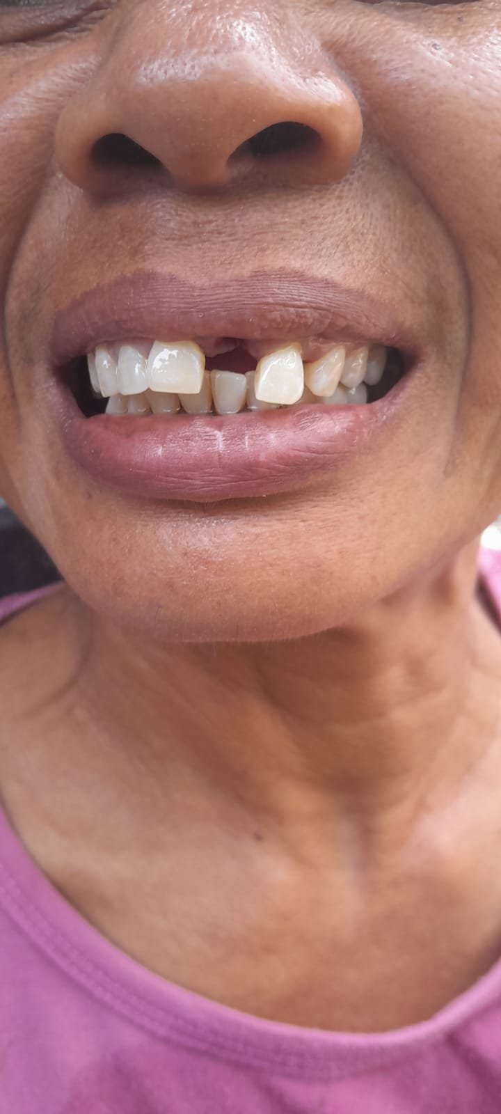 bali gigi tukang gigi dokter gigi bali reparasi gigi tambal gigi 9